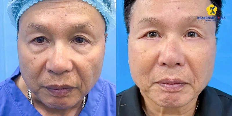 Bọng Mắt Chảy Xệ Phải Làm Sao