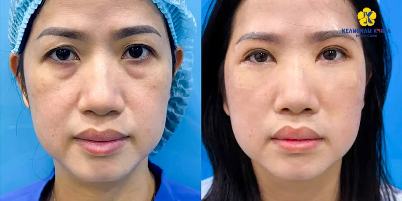 Bọng Mắt Chảy Xệ Phải Làm Sao