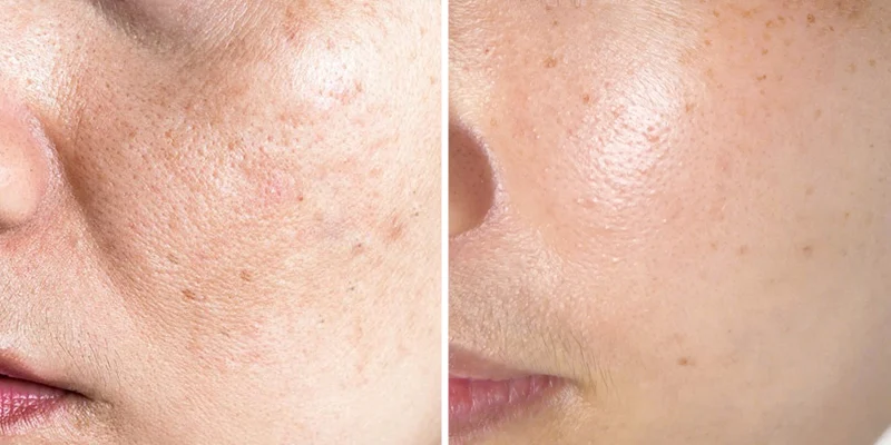 Cách Trị Đốm Nâu Trên Gò Má: Phân Biệt Nám, Tàn Nhang, Đồi Mồi Để Không Làm Sắc Tố Đậm Thêm 2 cách trị đốm nâu trên gò má