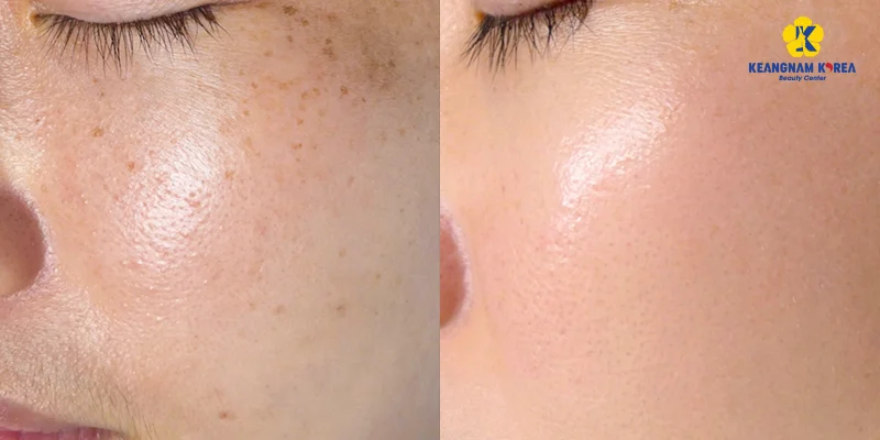 Cách Trị Đốm Nâu Trên Gò Má: Phân Biệt Nám, Tàn Nhang, Đồi Mồi Để Không Làm Sắc Tố Đậm Thêm 5 cách trị đốm nâu trên gò má