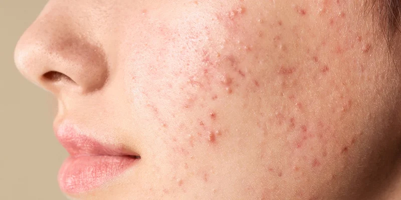 da mụn ẩn có tiêm meso được không