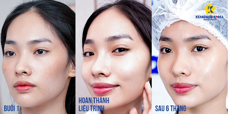 Cấy trắng da mặt giá bao nhiêu