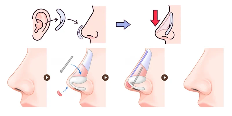Nâng Mũi Bọc Sụn Tai Được Bao Lâu: 5 Yếu Tố Quyết Định Độ Bền Và Đẹp Không Phải Ai Cũng Biết 3 Nâng mũi bọc sụn tai được bao lâu?
