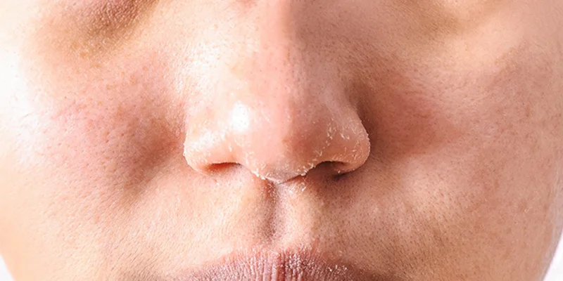 Da mất nước, khô ráp và thiếu độ căng bóng
