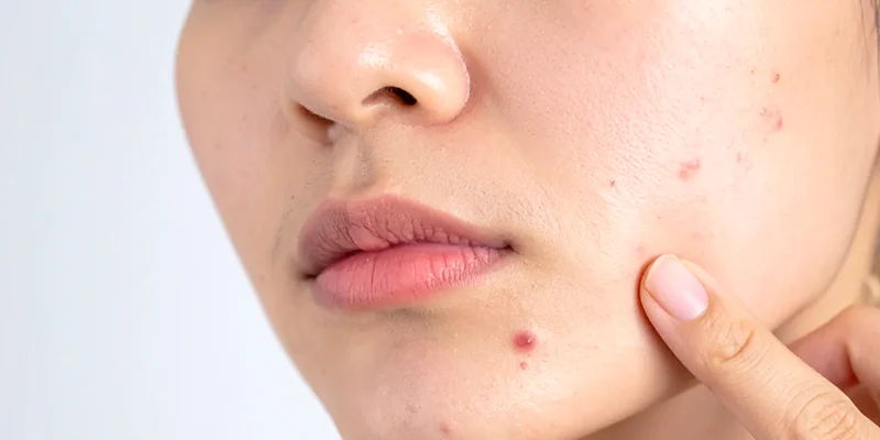 da mụn ẩn có tiêm meso được không