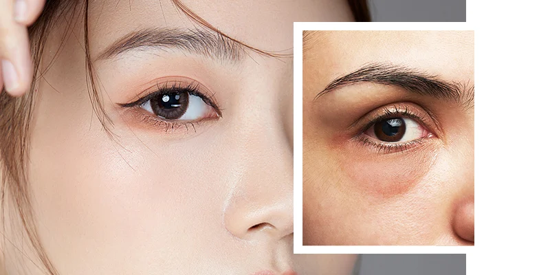 how to get rid of dark circles under eyes
