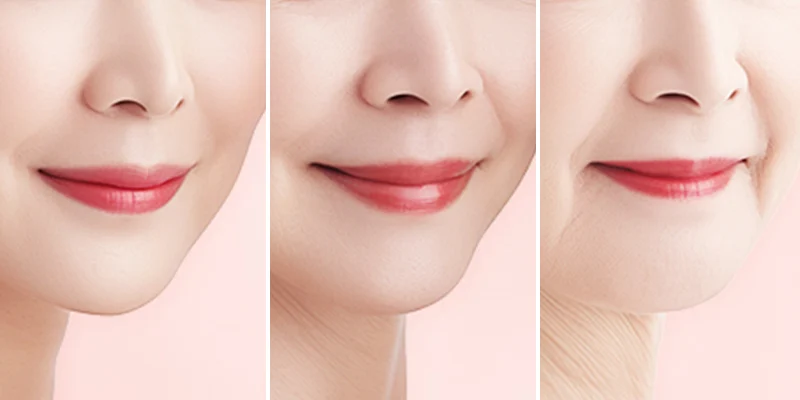 làm đầy rãnh cười