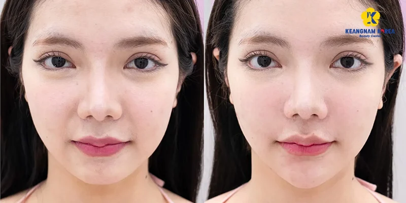 làm đầy rãnh cười