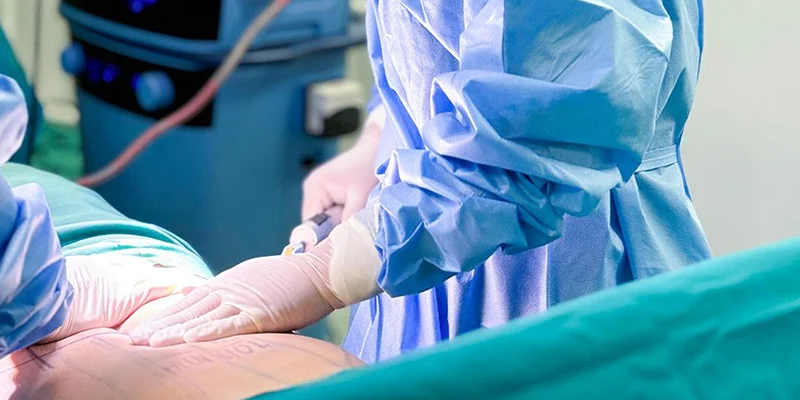 làm đầy rãnh cười bằng mỡ tự thân