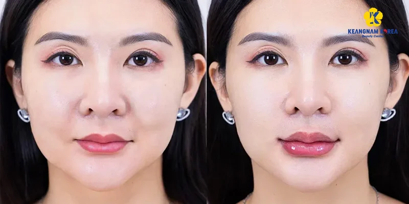 làm đầy rãnh cười