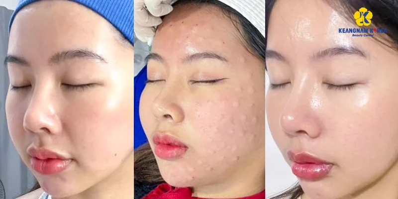 làm prp bao lâu thì đẹp