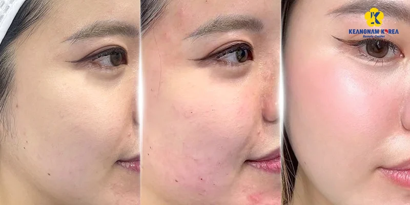 làm prp bao lâu thì đẹp