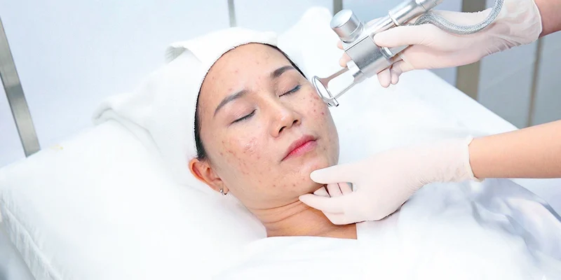 Cách Trị Đốm Nâu Trên Gò Má: Phân Biệt Nám, Tàn Nhang, Đồi Mồi Để Không Làm Sắc Tố Đậm Thêm 3 cách trị đốm nâu trên gò má
