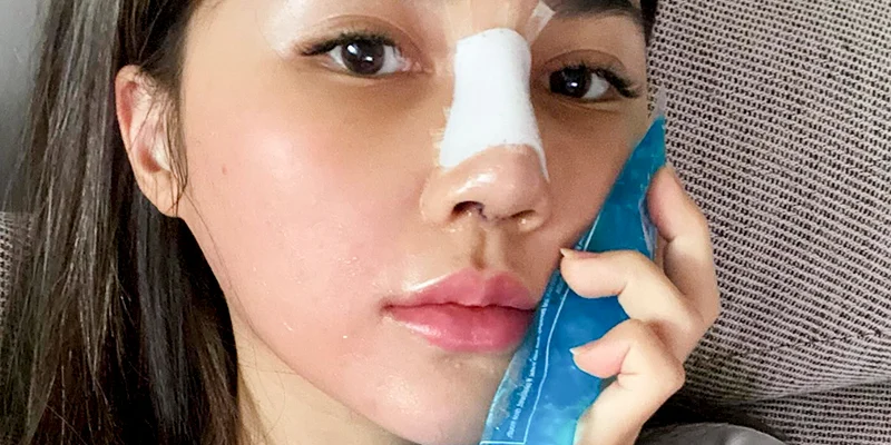 nâng mũi bị lệch nhẹ