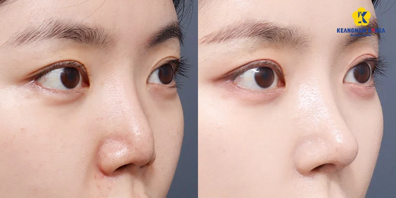 nâng mũi bị lệch nhẹ