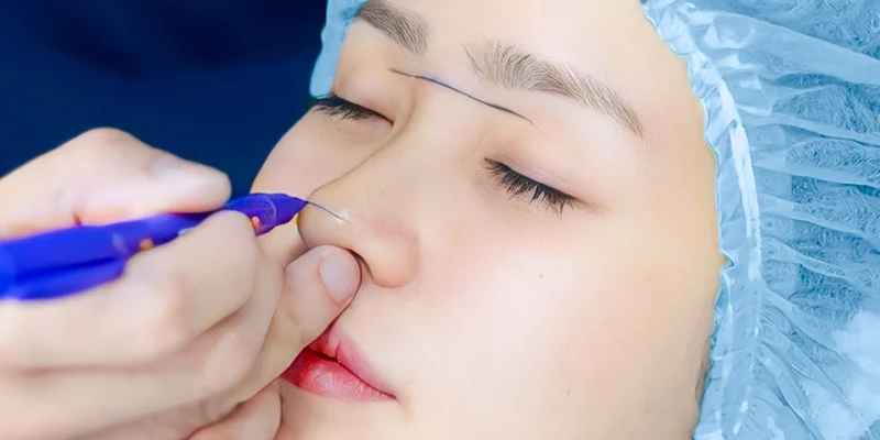 Nâng Mũi Bọc Sụn Tai Được Bao Lâu: 5 Yếu Tố Quyết Định Độ Bền Và Đẹp Không Phải Ai Cũng Biết 4 Nâng mũi bọc sụn tai được bao lâu?
