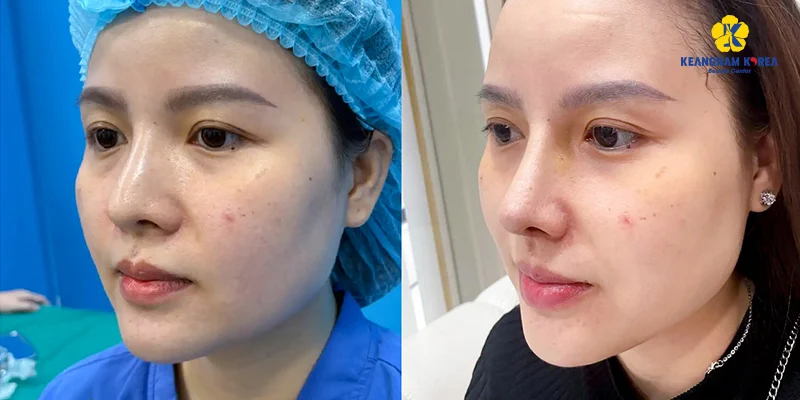 Nâng Mũi Bọc Sụn Tai Được Bao Lâu: 5 Yếu Tố Quyết Định Độ Bền Và Đẹp Không Phải Ai Cũng Biết 2 Nâng mũi bọc sụn tai được bao lâu?