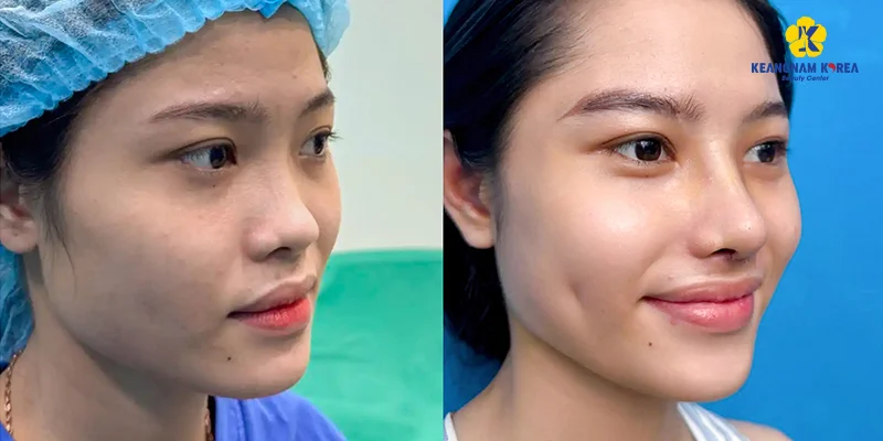 Nâng Mũi Bọc Sụn Tai Được Bao Lâu: 5 Yếu Tố Quyết Định Độ Bền Và Đẹp Không Phải Ai Cũng Biết 6 Nâng mũi bọc sụn tai được bao lâu?