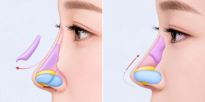 Nâng Mũi Cấu Trúc Có Vĩnh Viễn Không? Dáng Mũi Trông Ra Sao Khi Về Già 2 nâng mũi cấu trúc có vĩnh viễn không