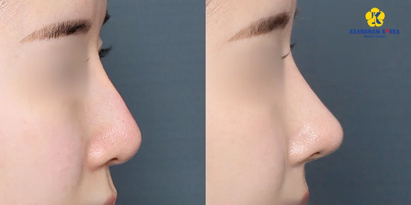 Nâng Mũi Cấu Trúc Có Vĩnh Viễn Không? Dáng Mũi Trông Ra Sao Khi Về Già 5 nâng mũi cấu trúc có vĩnh viễn không