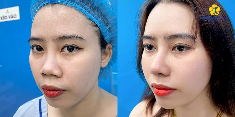 Nâng Mũi Cấu Trúc Sụn Sườn Sinh Học Là Gì: Loại Sụn, Độ Bền Và Giá 2026 4 nâng mũi cấu trúc sụn sườn sinh học