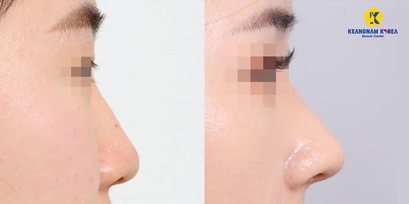 nên nâng mũi sụn sườn hay sụn tai