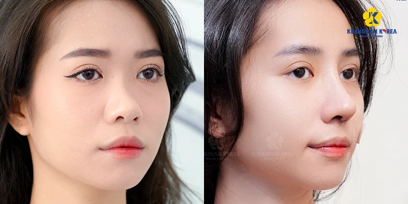 nên nâng mũi sụn sườn hay sụn tai