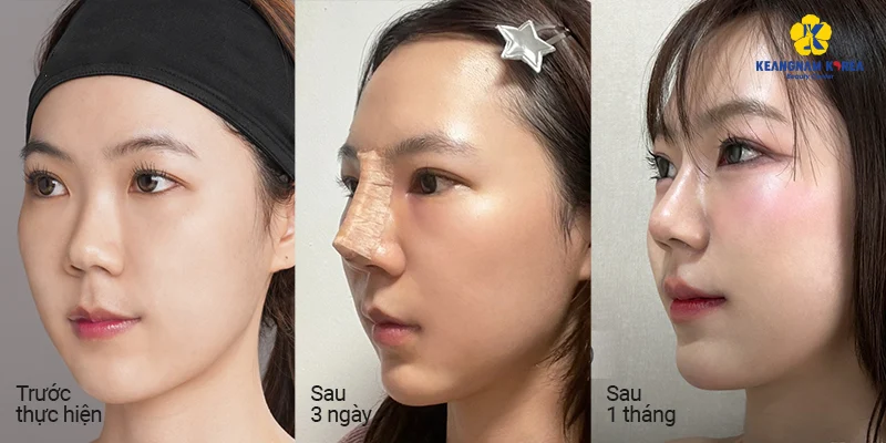 nose surgery recovery time