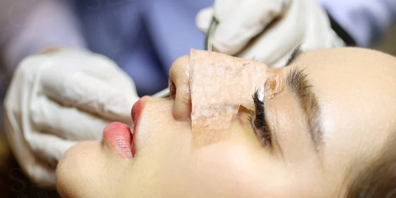 nose surgery recovery time