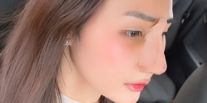 nose surgery recovery time