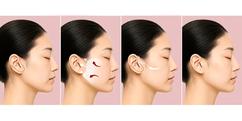 Phẫu thuật căng da mặt là gì