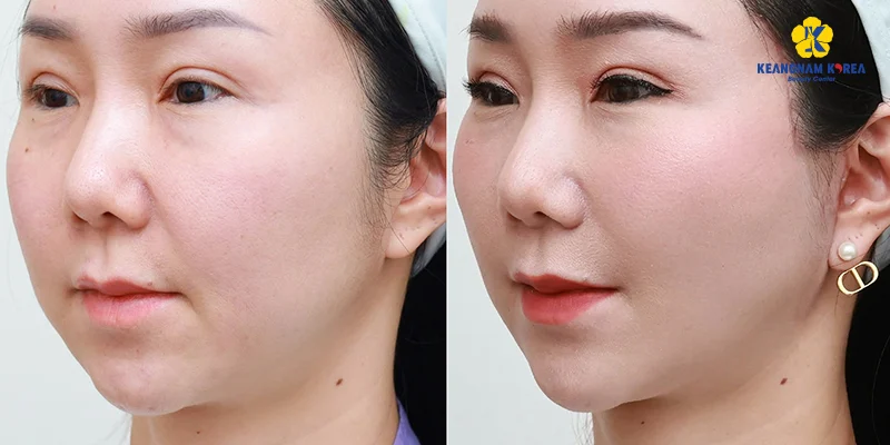 Phẫu thuật căng da mặt là gì