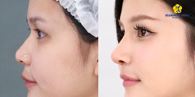Top 5 Rhinoplasty Clinics in Ho Chi Minh 2 Rhinoplasty Clinics in Ho Chi Minh