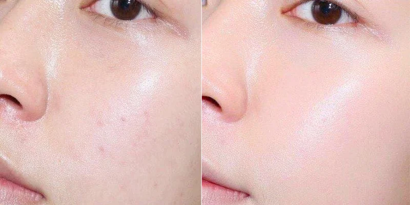 Tiêm collagen có đau không?