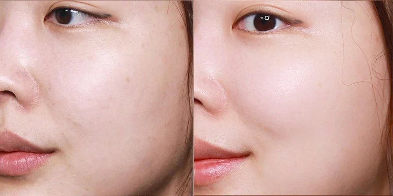 Tiêm collagen có đau không?
