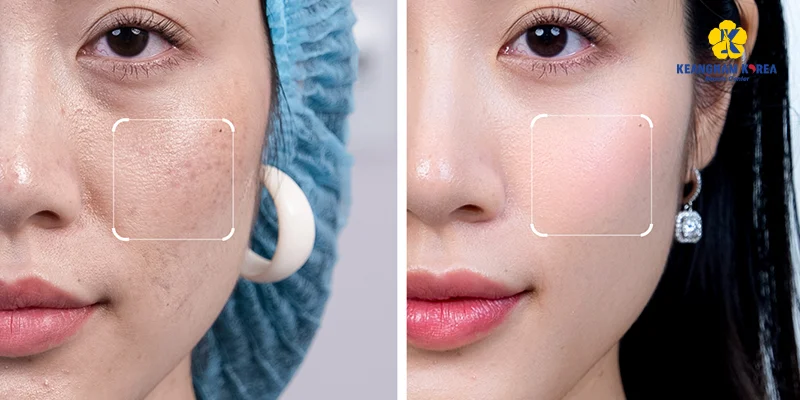 Tiêm collagen có tốt không