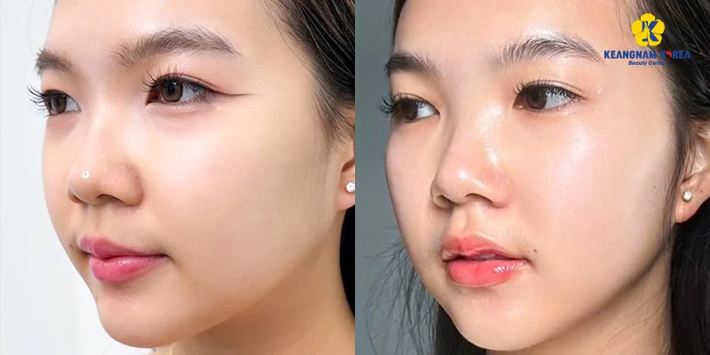 Tiêm Meso Bao Nhiêu Tiền 1 Lần? Bảng Giá 2026 Theo 8 mục đích tiêm khác nhau 5 Tiêm Meso Bao Nhiêu Tiền 1 Lần