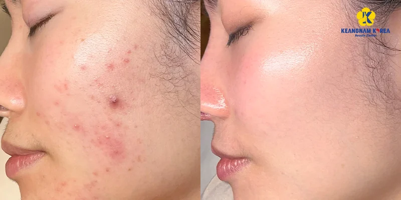 Tiêm meso có trị mụn không?