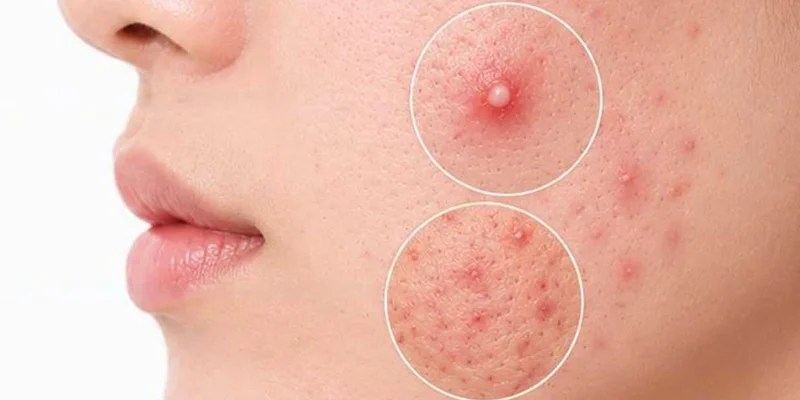 Tiêm meso có trị mụn không?