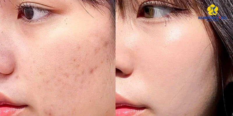 Tiêm Meso Trị Mụn Giá Bao Nhiêu? Bao Lâu Hết Mụn Và Bao Lâu Hết Thâm? 3 tiêm meso trị mụn giá bao nhiêu