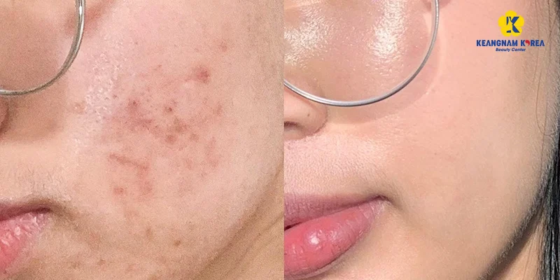 Tiêm Meso Trị Mụn Giá Bao Nhiêu? Bao Lâu Hết Mụn Và Bao Lâu Hết Thâm? 4 tiêm meso trị mụn giá bao nhiêu