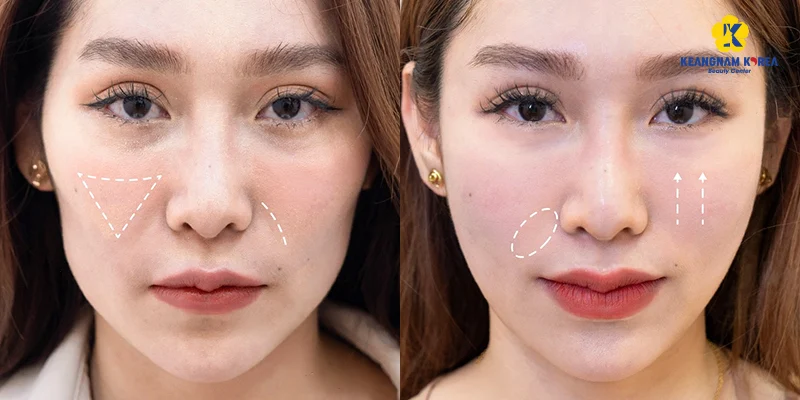 Tiêm rãnh cười gồm những phương pháp gì?