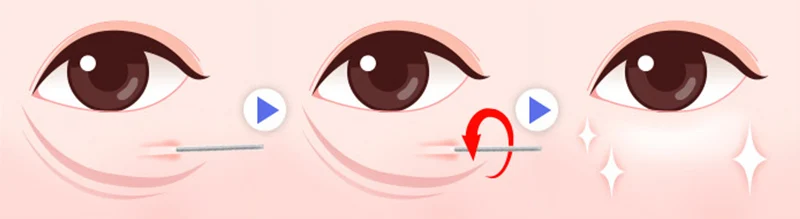 Xóa Bọng Mắt Không Phẫu Thuật